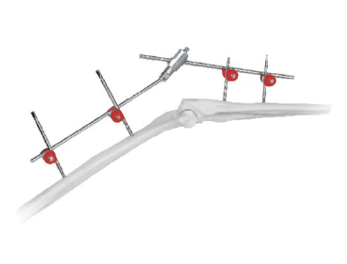 骨科外固定支架的治療效果怎樣？會(huì)產(chǎn)生什么并發(fā)癥嗎？